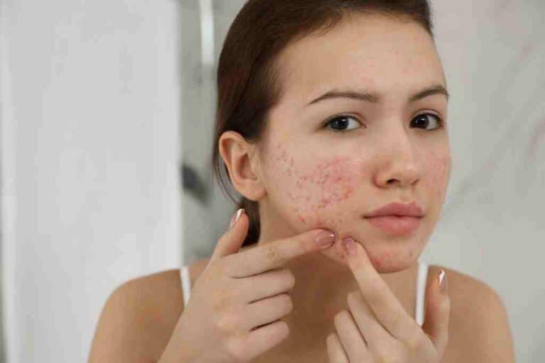 best vegan skincare for acne: A Cruelty-Free Approach To Clear Skin